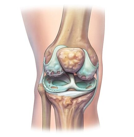 Vernietiging van de gewrichten met de ontwikkeling van osteochondrose