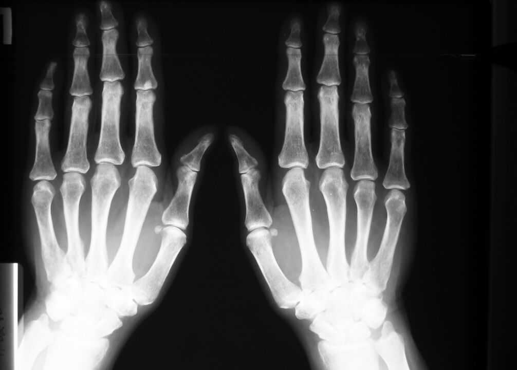röntgenfoto om pijn in de gewrichten van de vingers te diagnosticeren