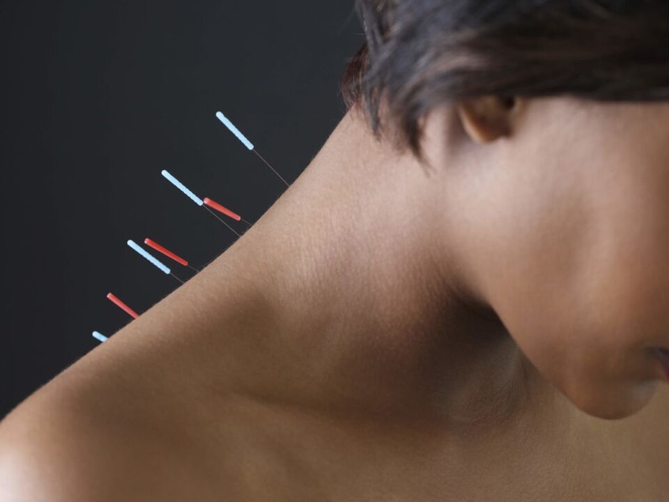 Acupunctuur voor cervicale osteochondrose elimineert ontstekingsprocessen